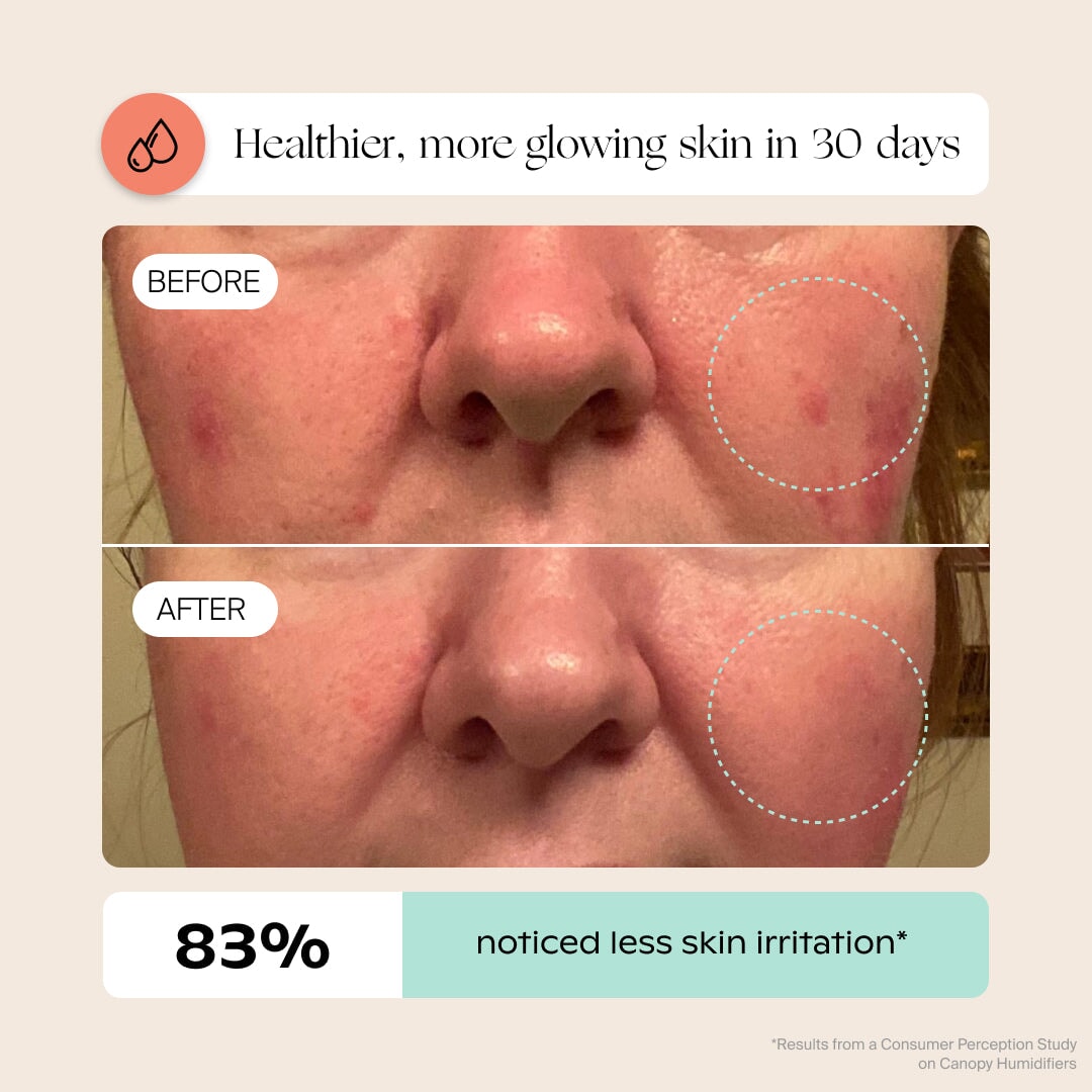 A close-up shows cheeks before and after using the Canopy Bedside Humidifier 2.0. The "Before" image has red, irritated skin, while the "After" reveals smoother skin. Caption: "Achieve healthier, glowing skin in 30 days. 83% noticed less irritation." Fulfilled by Canopy.